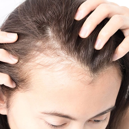 Affordable hair loss treatment in Chennai to reduce hair fall and stimulate new hair growth